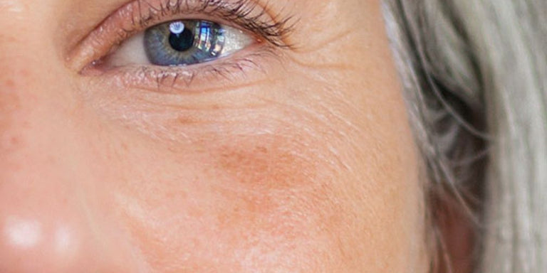 Gesichtspflege bei Pigmentflecken