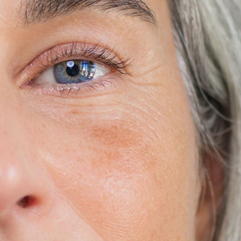 Gesichtspflege bei Pigmentflecken