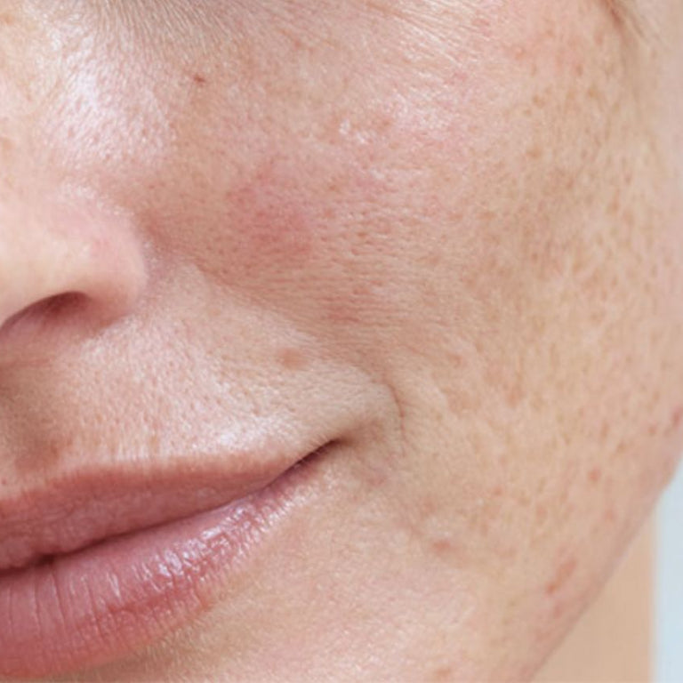 Hautpflege Rosacea