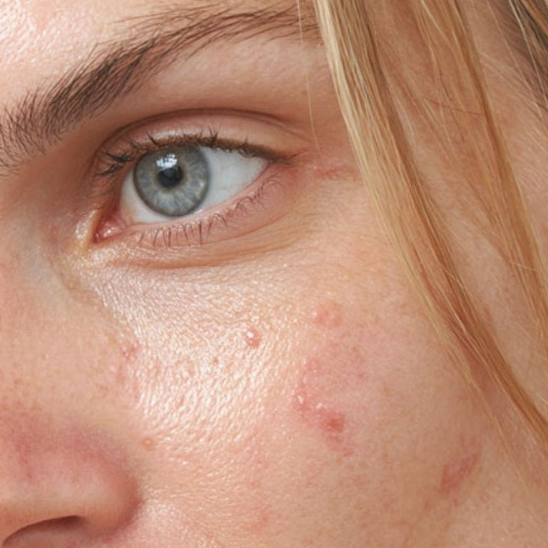 Gesichtspflege bei Akne