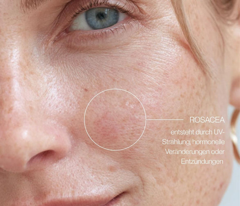 Close-up von Rosacea im Gesicht mit Text zu Auslösern