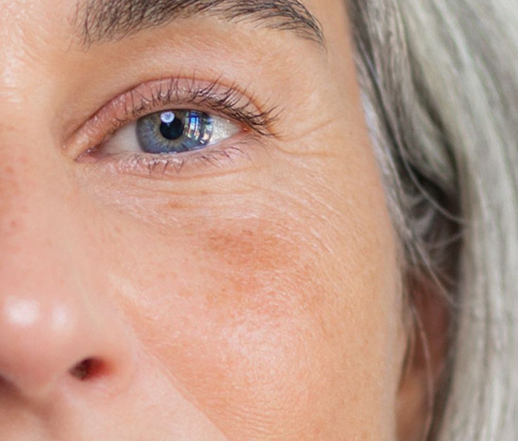 Gesichtspflege bei Pigmentflecken