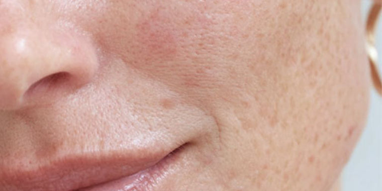 Hautpflege Rosacea
