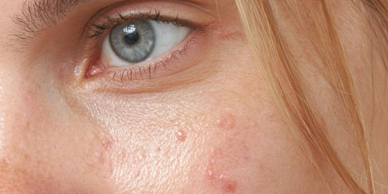 Gesichtspflege bei Akne