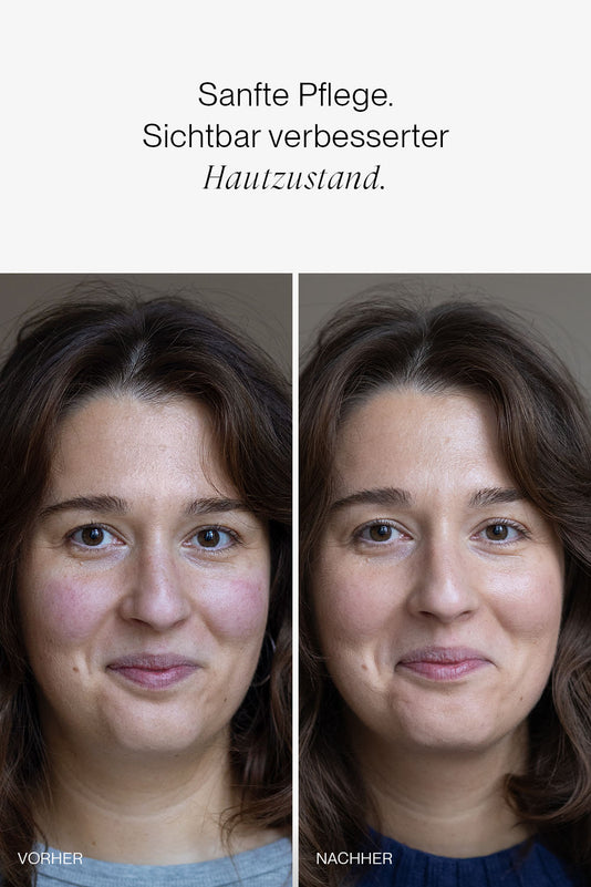 vorher-nachher Ergebnis der JACKS beauty line Skincare Reihe