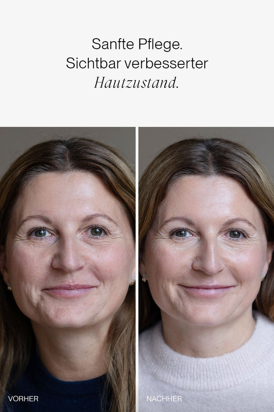 vorher-nachher Ergebnis der JACKS beauty line Skincare Reihe