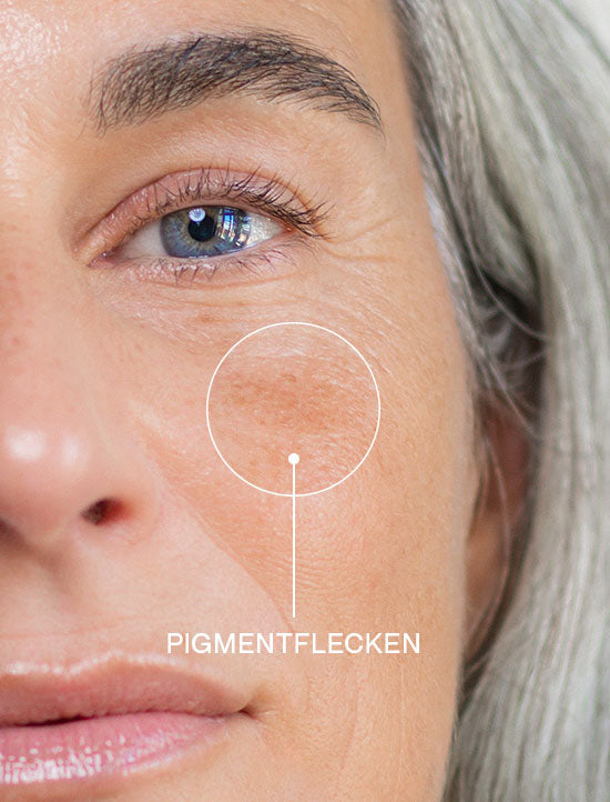 Close-up einer Frau Ü50 mit Zoom auf Pigmentflecken