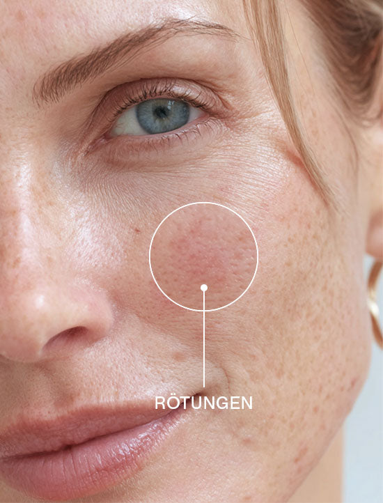Close-up einer Frau mit Zoom auf Rötungen