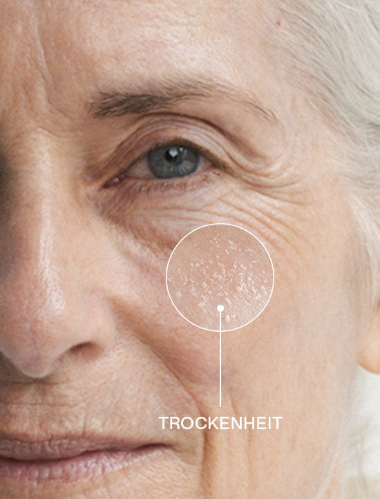 Close-up einer Frau Ü50 mit Zoom auf eine trockene Hautstelle