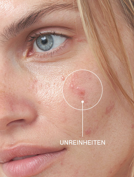 Close-up einer Frau mit Zoom auf Unreinheiten
