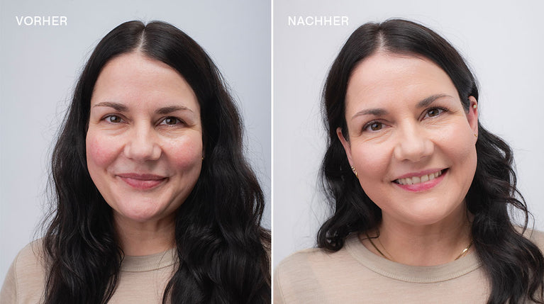 Frau mit dunklen Haaren und Rosacea im Vorher Nachher Vergleich mit und ohne Make-up