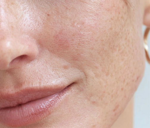 Close-up von Rosacea im Gesicht einer Frau
