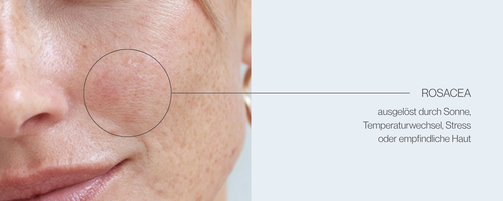 Close-up von Rosacea im Gesicht mit Text zu Auslösern 
